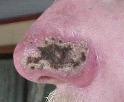 Рак носа